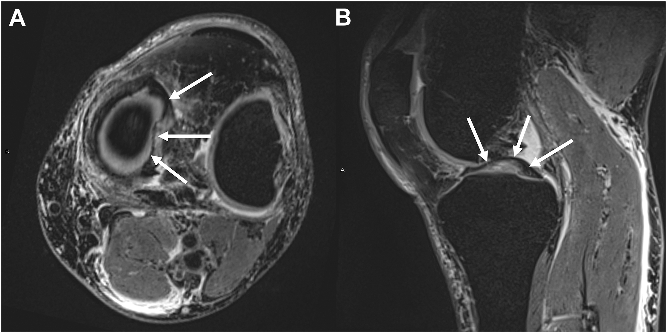 A two-panel 3 D M R I of a right knee shows a complex bucket handle tear of the medial meniscus, with arrows marking a large displaced flap in the intercondylar notch.