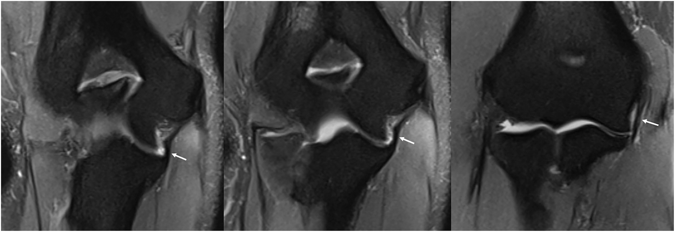 Three M R I scans of an elbow show a thickened ulnar collateral ligament indicated by arrows.
