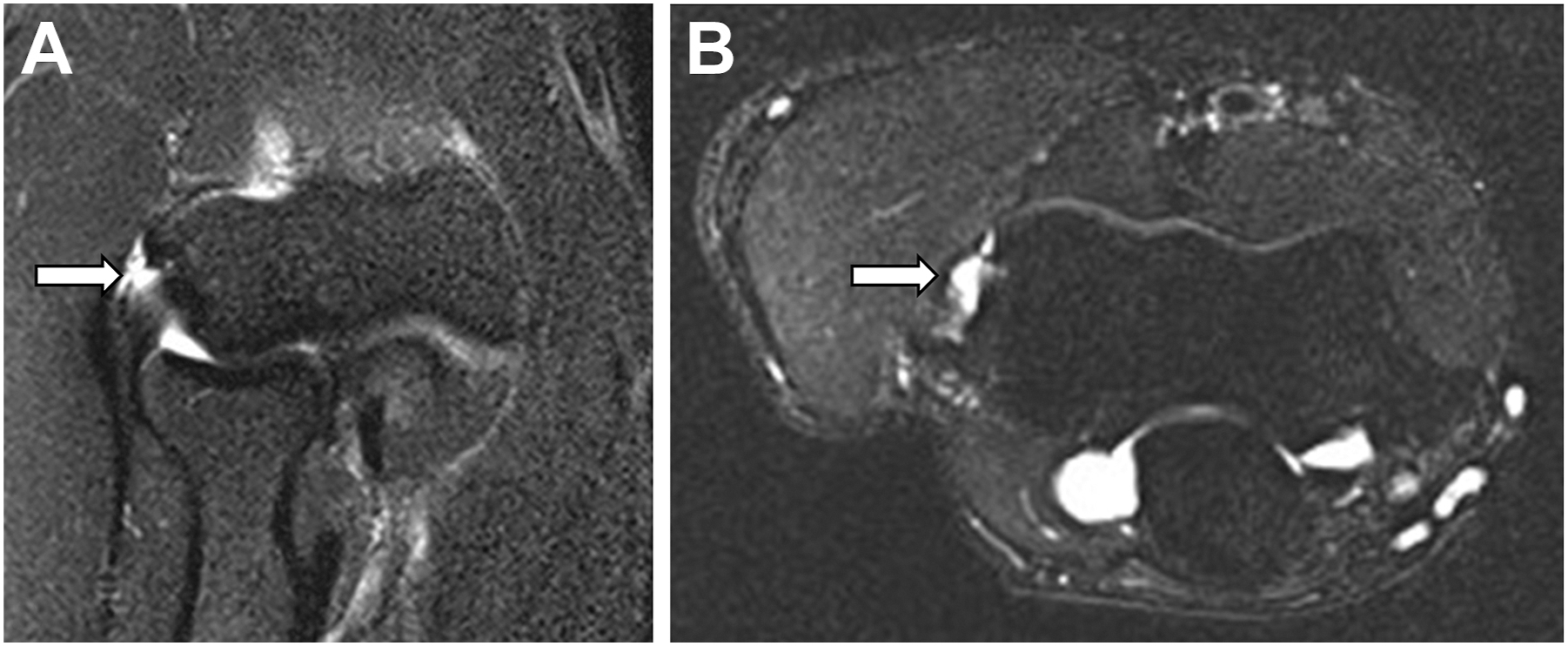 A coronal and axial elbow scan shows tendon thickening with a high-grade partial tear at the attachment near the outer joint.