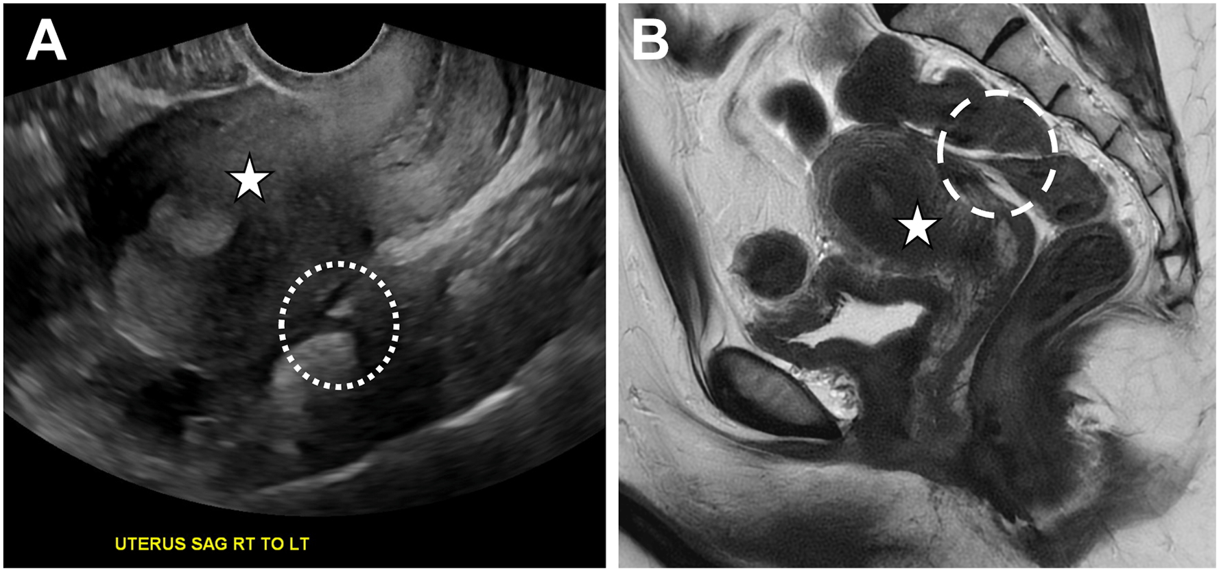 Two panels show bowel tethering with beak-like anterior rectal wall angulation toward the posterior uterine serosa on transvaginal ultrasound and T 2-weighted M R I.