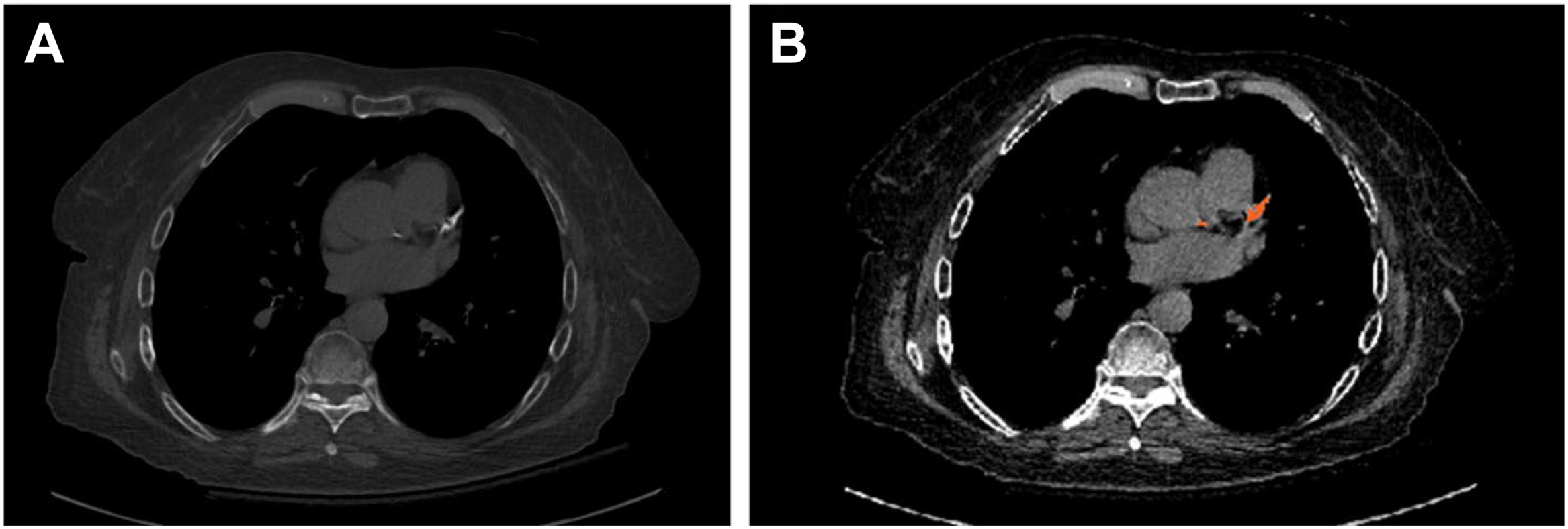 Two panels with axial non-contrast C T images of the chest showing incidental coronary artery calcification in a 69-year-old woman after a fall, highlighted with a color overlay in the left anterior descending artery.