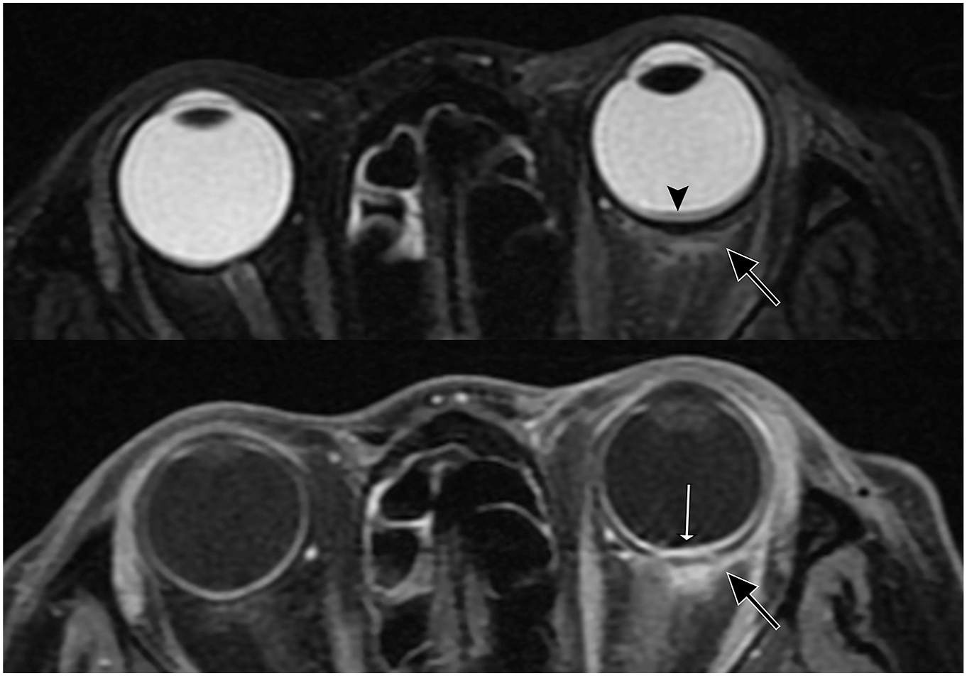 Two M R I scans show left posterior scleritis with scleral thickening, episcleral oedema, and reactive subretinal fluid.