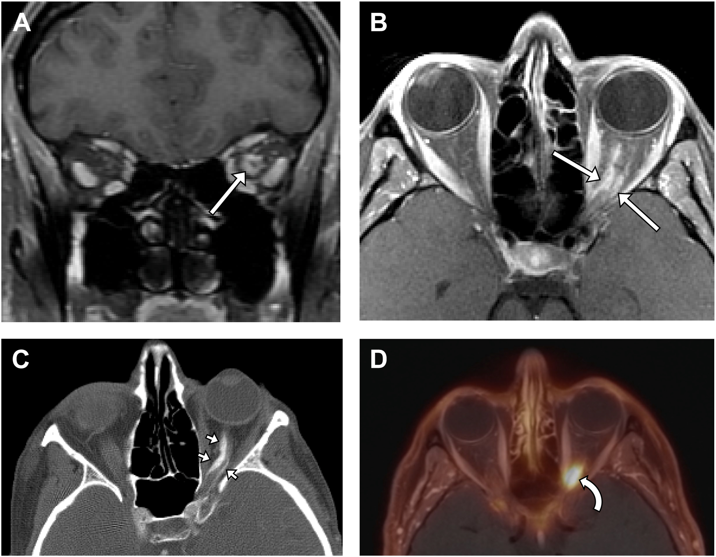 A series of four scans demonstrates an optic nerve sheath meningioma, featuring circumferential tram-track enhancement, typical calcification, and high somatostatin receptor density avidity.