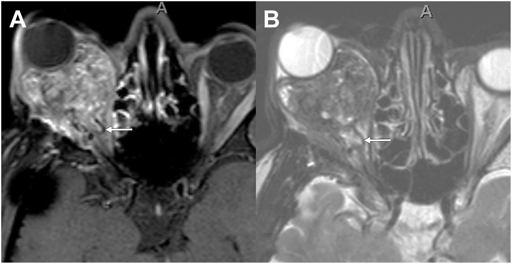 A two-part magnetic resonance imaging scan shows a recurrent anaplastic solitary fibrous tumor in the right orbit, causing significant proptosis, with arrows pointing to flow voids.