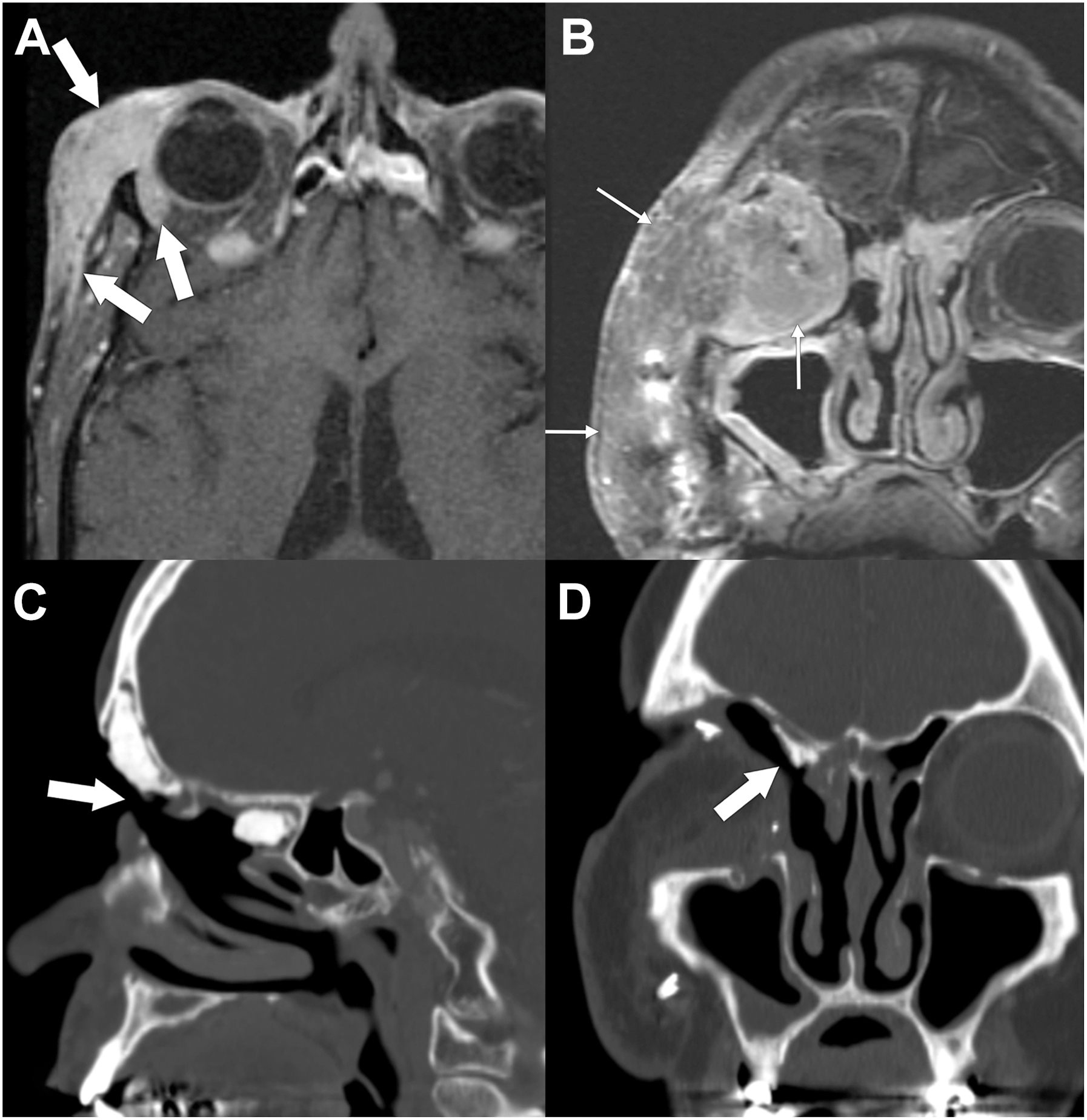 A set of four radiological scans shows magnetic resonance imaging and computed tomography scans of a patient with a right eyelid squamous cell carcinoma.