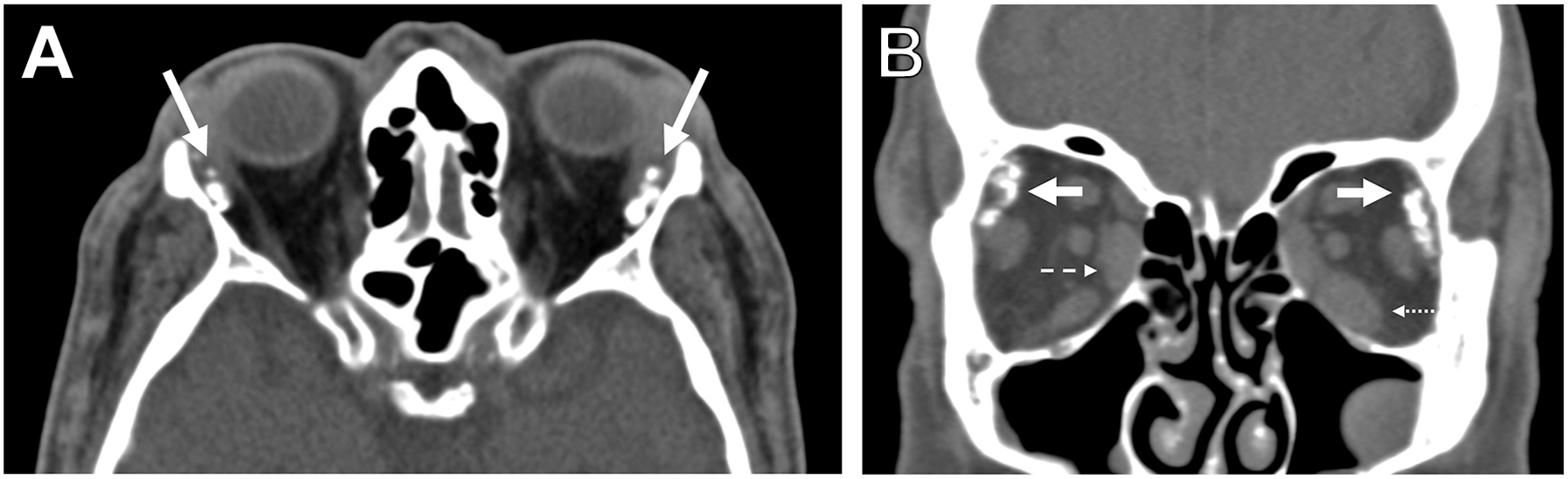 A two-panel non-contrast computed tomography scan of a 67-year-old male with amyloidosis shows stippled coarse calcifications in the lacrimal glands and extraocular muscle enlargement.