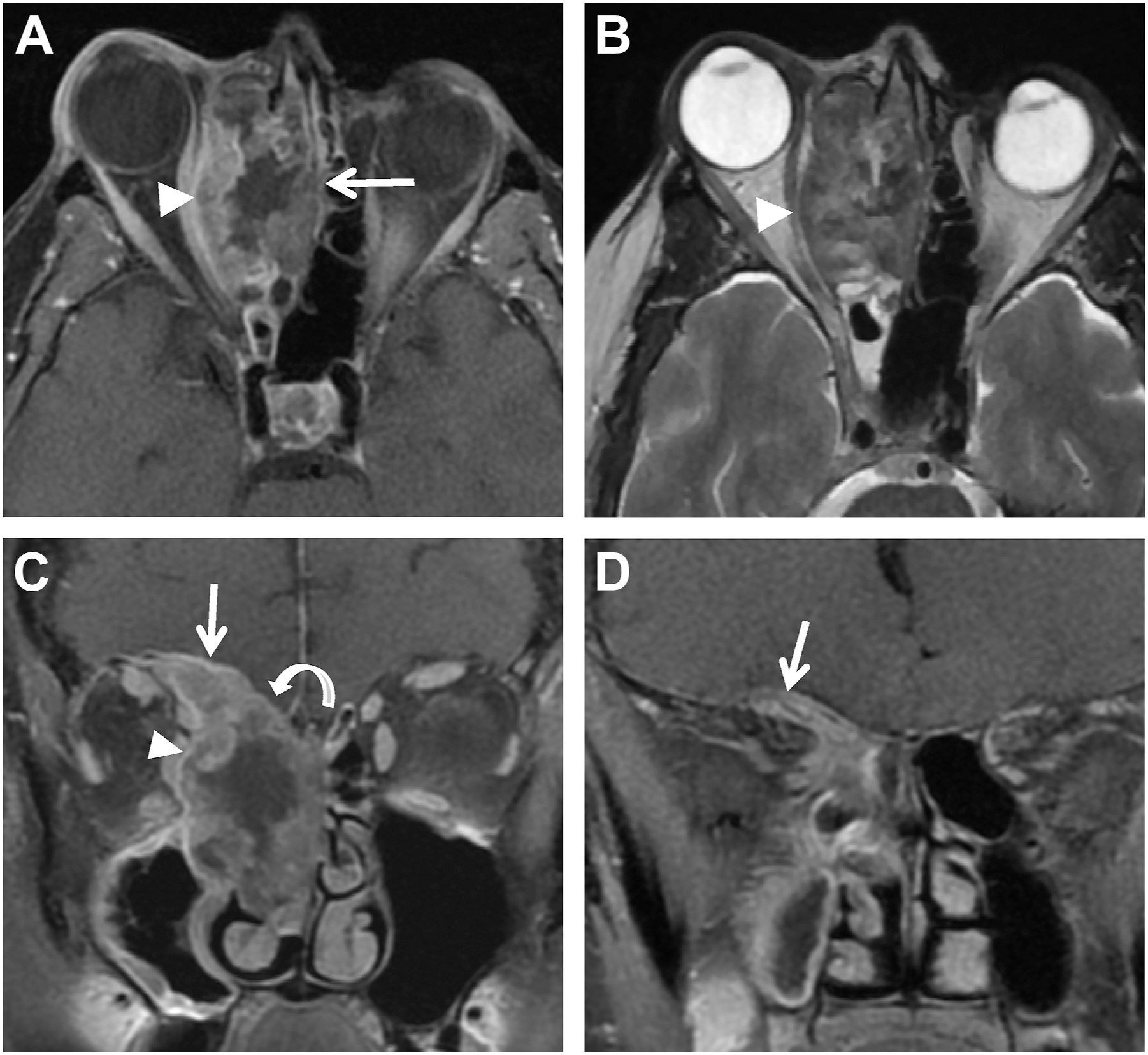 A four-panel magnetic resonance image series shows a right ethmoid and nasal mass with orbital and cranial extension.