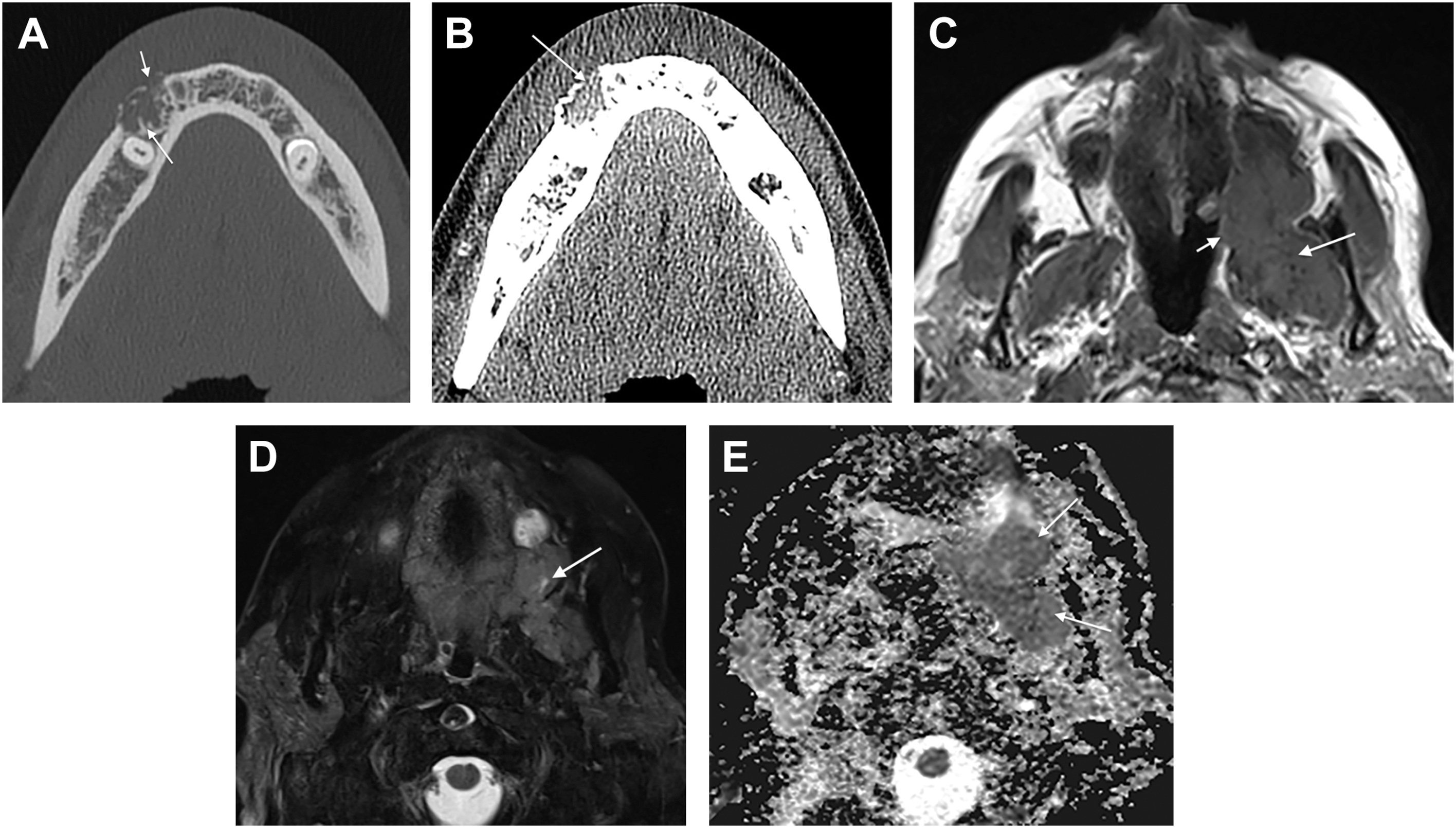 Five medical imaging scans show a dense mandibular mass with restricted diffusion and high cellularity, suggesting malignant odontogenic tumor pathology.