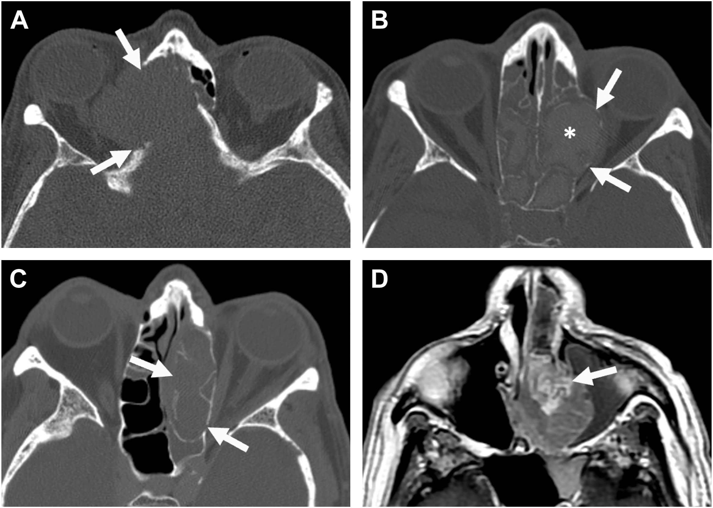 An axial series of C T and M R I scans with arrows and asterisk indicates lesions masses and anatomical abnormalities in nasal cavity sinuses and orbit across four different panels.