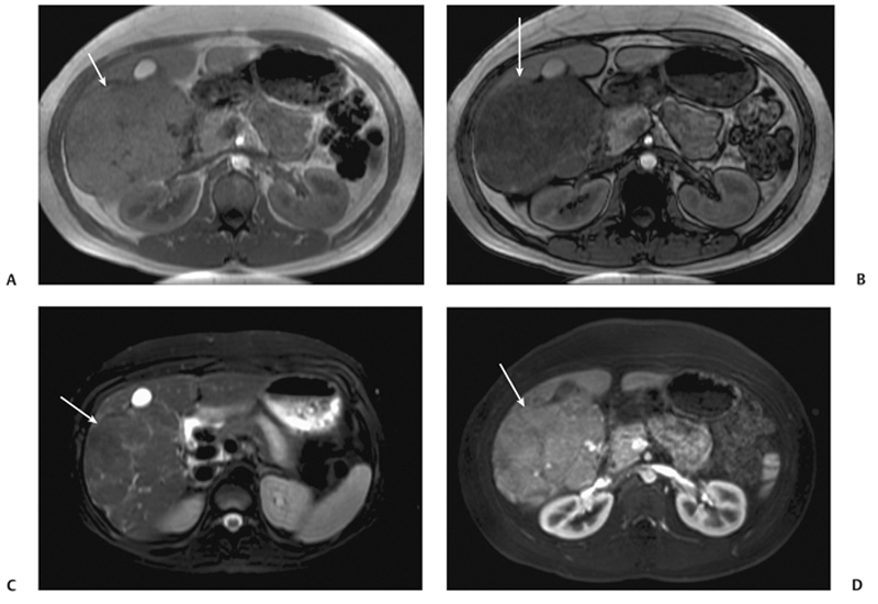 Liver Adenoma Radiology Key