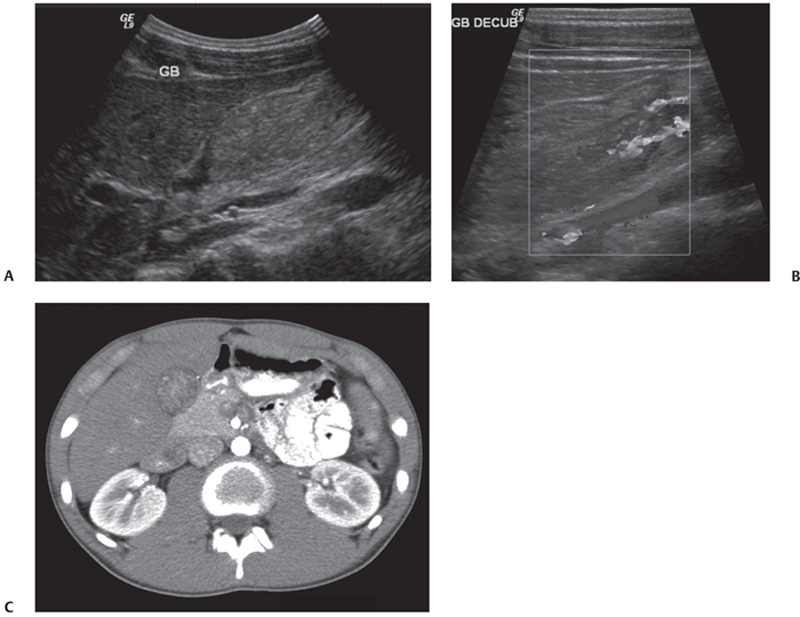 Gallbladder Polyp Histology