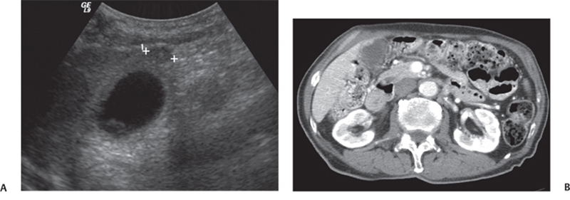 15 Adenomyomatosis Of Gallbladder Radiology Key