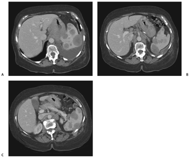 49 Secondary Involvement Of The Spleen In Lymphoma Radiology Key