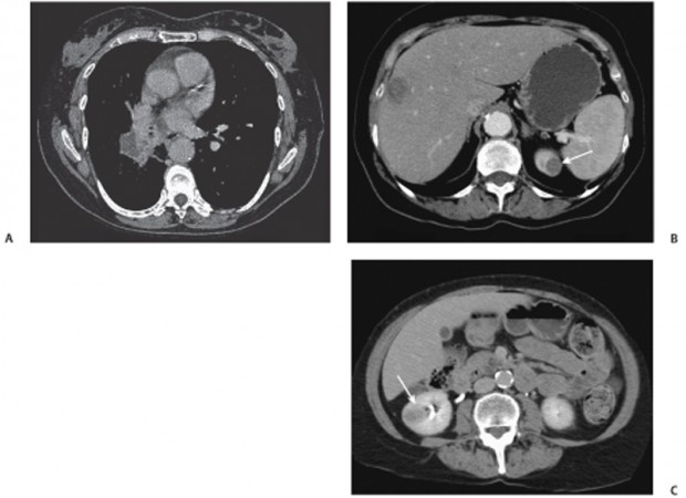 103 Dedifferentiated Retroperitoneal Liposarcoma | Radiology Key