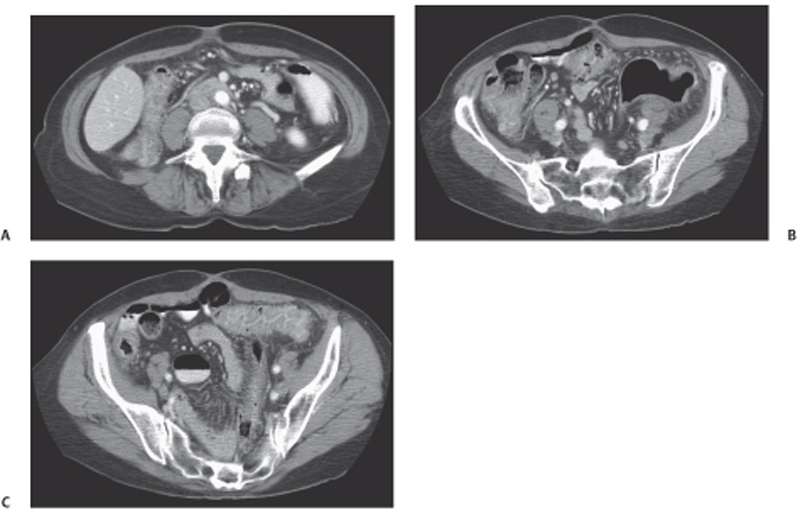 85 Infectious Colitis Radiology Key