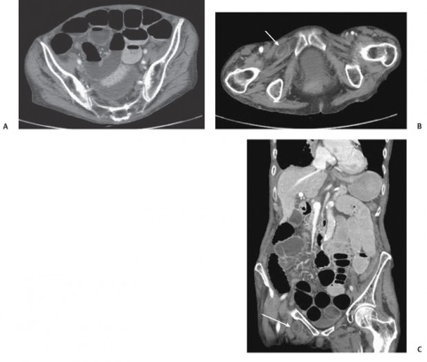 104 Small Bowel Carcinoid with Mesenteric Metastases | Radiology Key