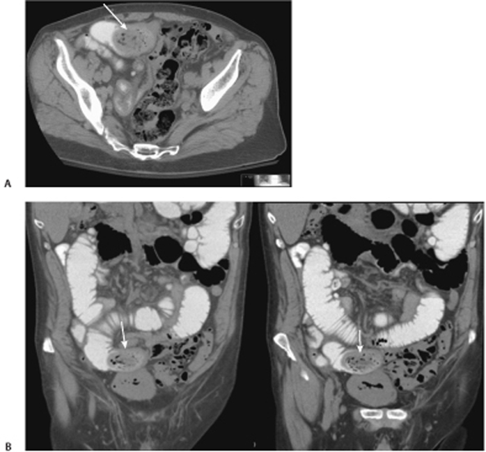 114 Mechanical Small Bowel Obstruction Secondary to Phytobezoar ...