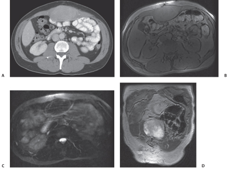 117 Anterior Abdominal Wall Desmoid Tumor Radiology Key