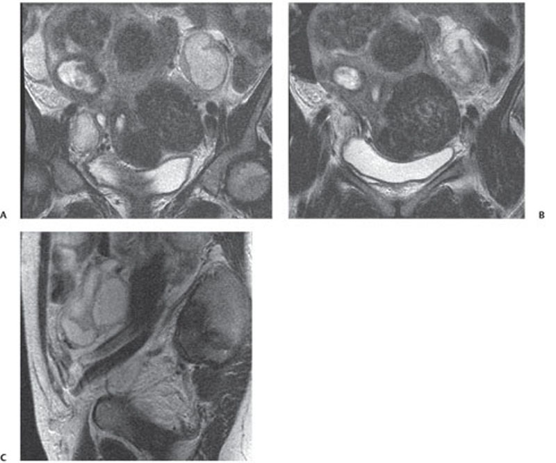 132 Pelvic Inflammatory Disease With Tubo-ovarian Abscess | Radiology Key