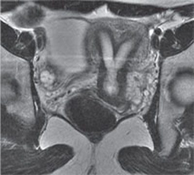 136 Bicornuate Uterus | Radiology Key