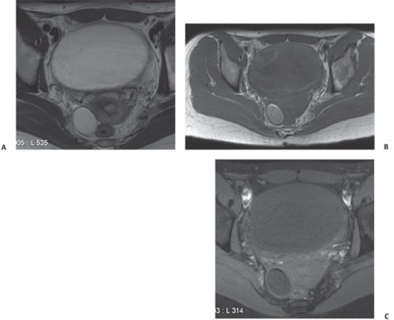 141 Mature Cystic Teratoma Dermoid Cyst Radiology Key