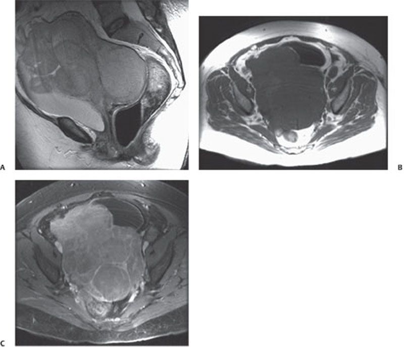 117 Anterior Abdominal Wall Desmoid Tumor Radiology Key