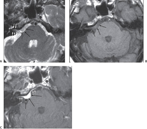 Meningioma | Radiology Key