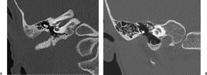 The External Auditory Canal and Pinna | Radiology Key