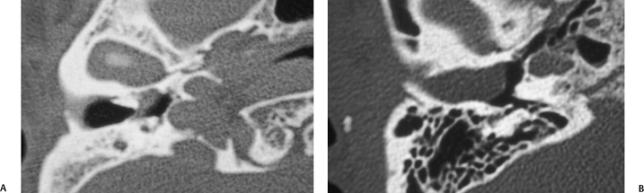 the-external-auditory-canal-and-pinna-radiology-key