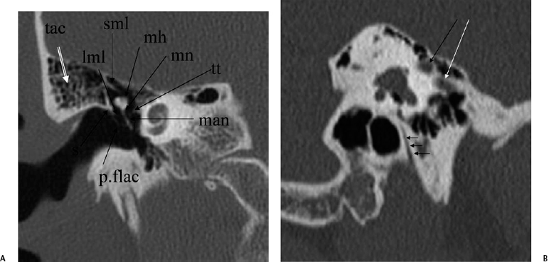 The Middle Ear and Mastoid | Radiology Key