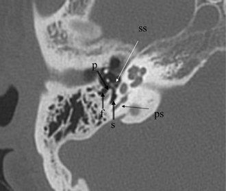 The Middle Ear and Mastoid | Radiology Key