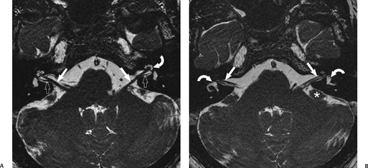 The Vestibulocochlear Nerve, with an Emphasis on the Normal and