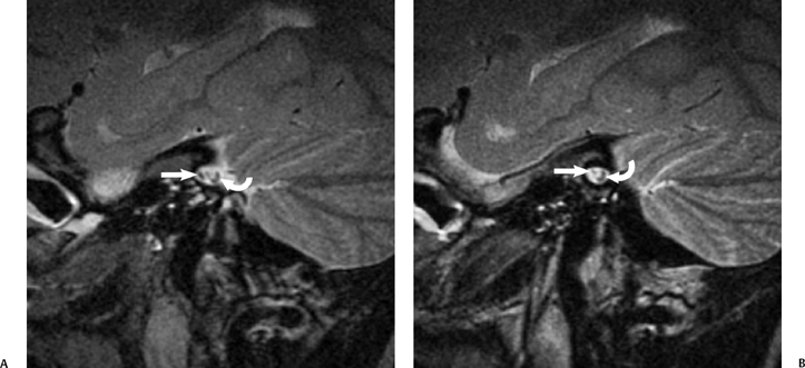 porus of internal auditory canal