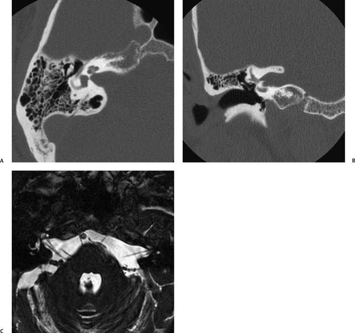 internal auditory canal mri cpt code