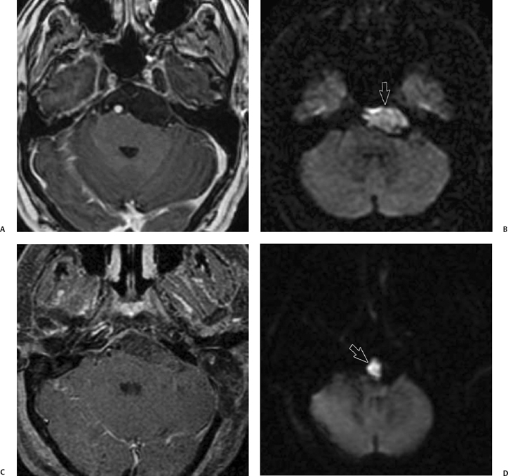 2 mm enhancing nodule in internal auditory canal