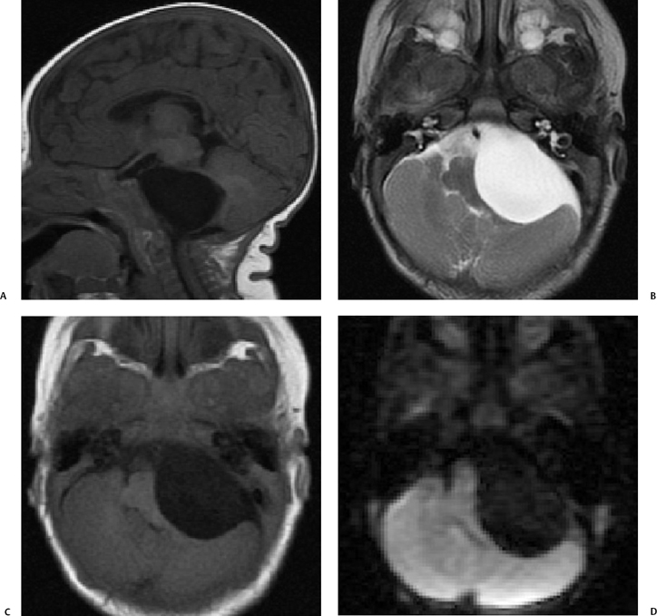 internal auditory canal cyst