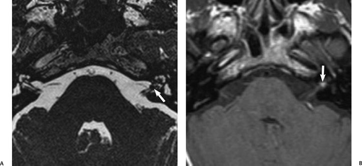 The Vestibulocochlear Nerve, with an Emphasis on the Normal and