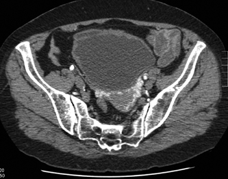 Pelvic congestion syndrome, Radiology Case
