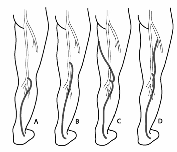 Clinical Review: Lower Extremity Venous Insufficiency | Radiology Key