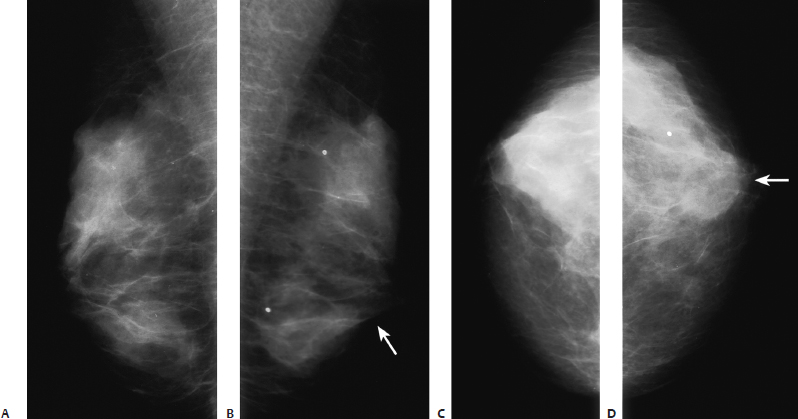 movable lump in breast