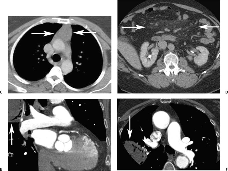 Calcium Scoring | Radiology Key