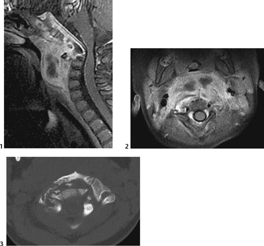 26 Retropharyngeal Abscess | Radiology Key