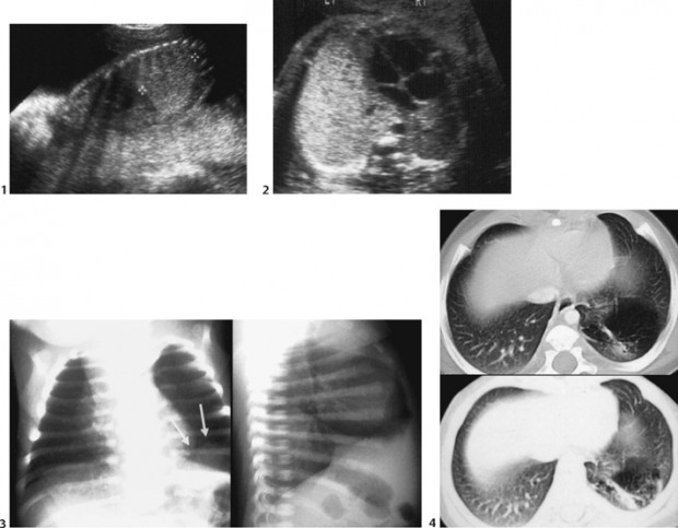 35 Congenital Diaphragmatic Hernia Radiology Key