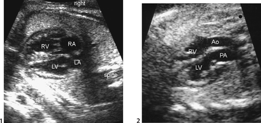 Transposition Of Great Arteries Ultrasound