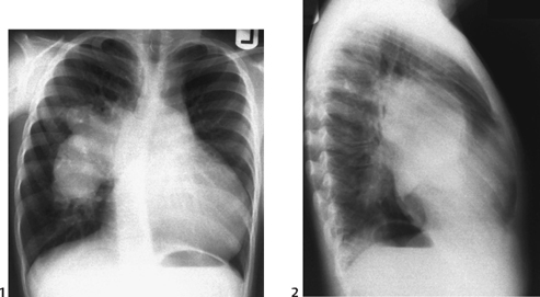 51 Absent Pulmonary Valve Syndrome | Radiology Key