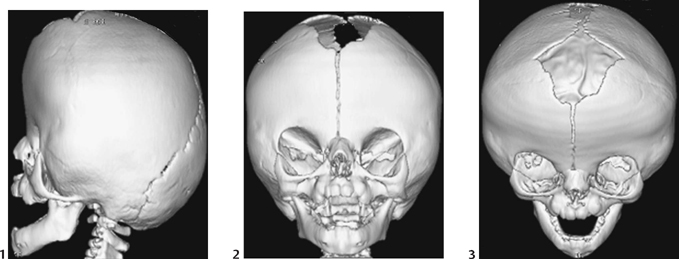 apert syndrome skull