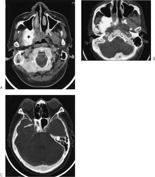 Osteosarcoma | Radiology Key