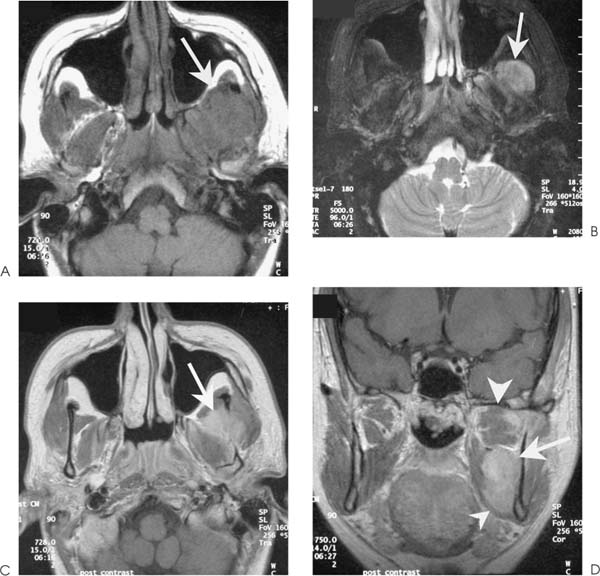 Rhabdomyosarcoma | Radiology Key