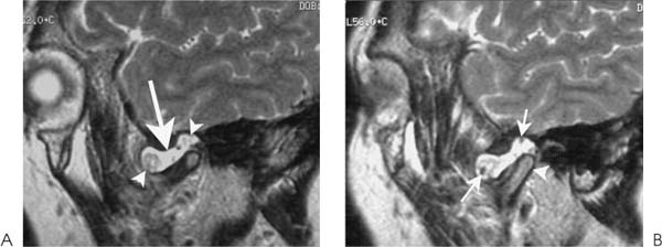 Synovial Chondromatosis | Radiology Key