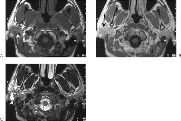 mucoepidermoid-carcinoma-radiology-key